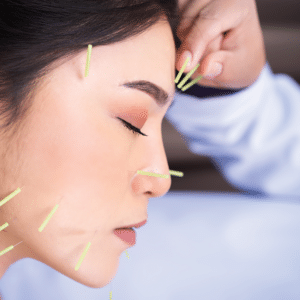 ACUPUNCTURE THERAPY ORMOND BEACH